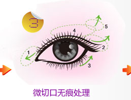 微切口无痕处理