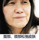 黄金微针