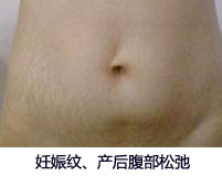 微针疗法
