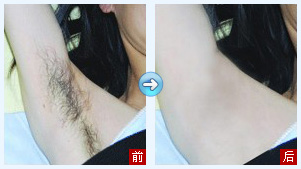 脱腋毛前后效果对比图