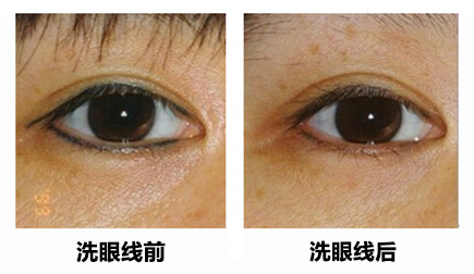 铜雀台激光洗眼线 安全无痛不留疤